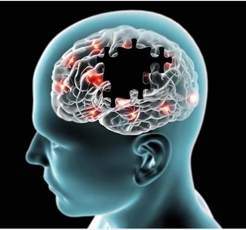 بهترین روش های درمان برای کند شدن پیشرفت بیماری آلزایمر